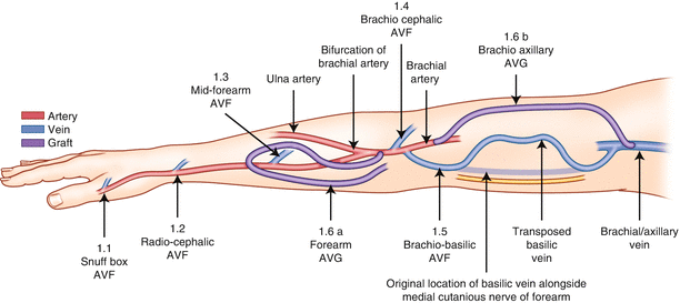 Vascular Access: Improving Outcomes for Haemodialysis Patients