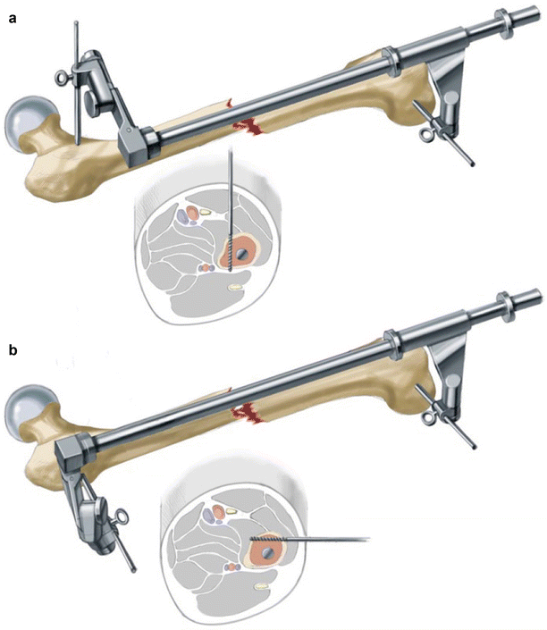 Femur Diaphysis Springerlink femur diaphysis springerlink