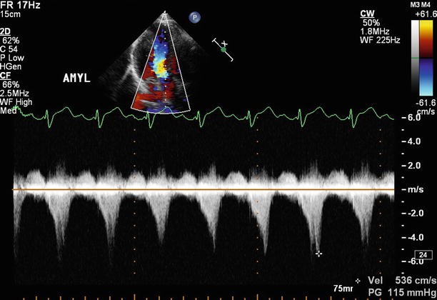 Hypertrophic Cardiomyopathy and Mitral Valve Disease | SpringerLink