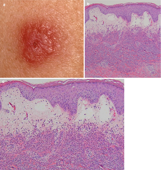 Neutrophilic Dermatoses Springerlink