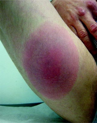 Cutaneous Manifestations Of Infectious Diseases Springerlink