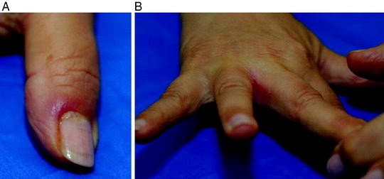 Cutaneous Manifestations Of Infectious Diseases Springerlink