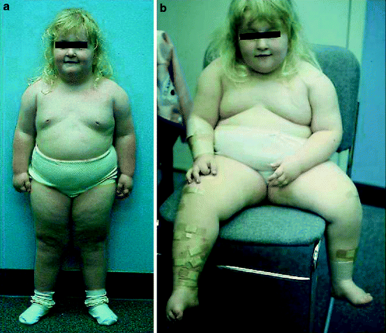 Williams Syndrome Naked