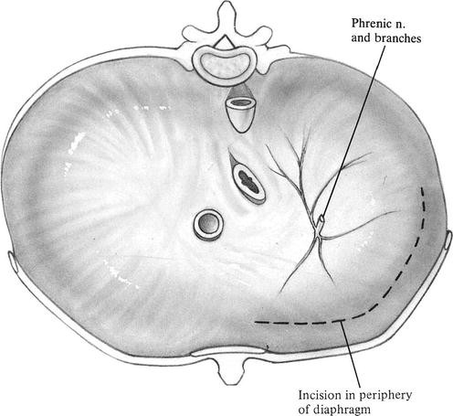 Esophagogastrectomy: Left Thoracoabdominal Approach | SpringerLink