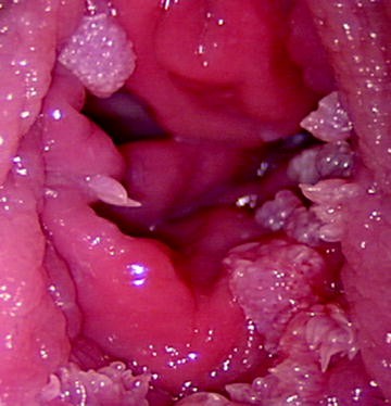 vestibular papillomatosis common)