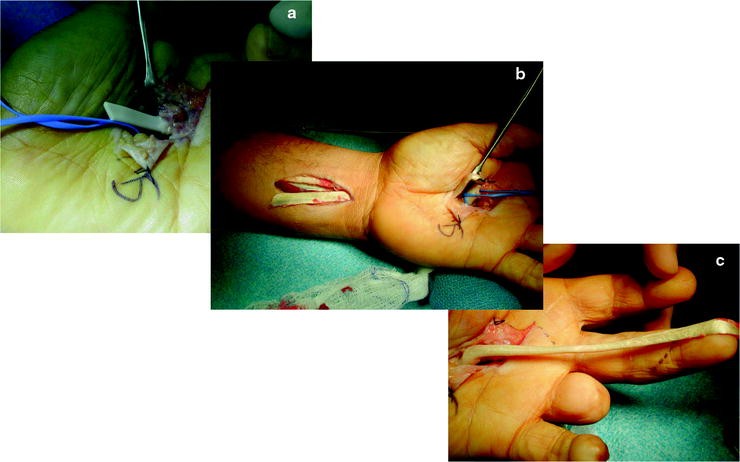 Options for Failed Flexor Tendon Surgery | SpringerLink