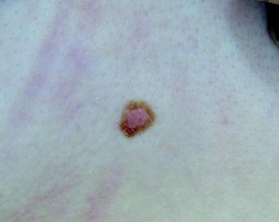 Nevoid Skin Findings Springerlink