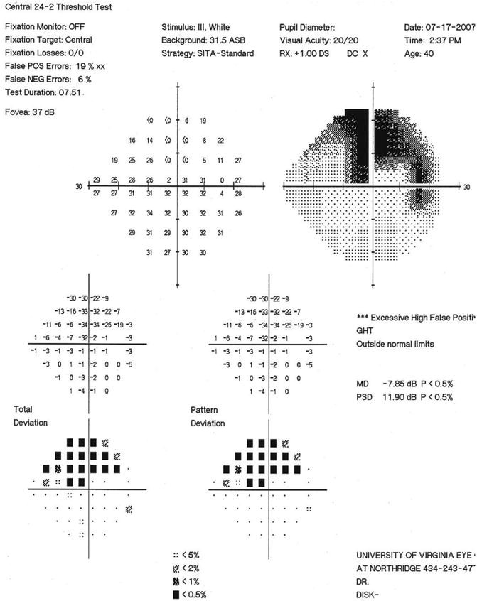 Normal Tension Glaucoma Springerlink