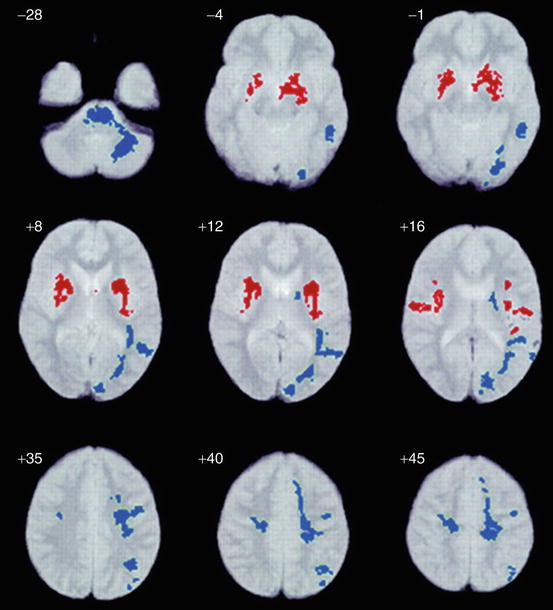 White Matter Brain Structure in Asperger's Syndrome | SpringerLink