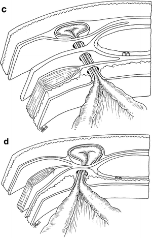 Spigelian Hernias: Diagnosis and Treatment | SpringerLink