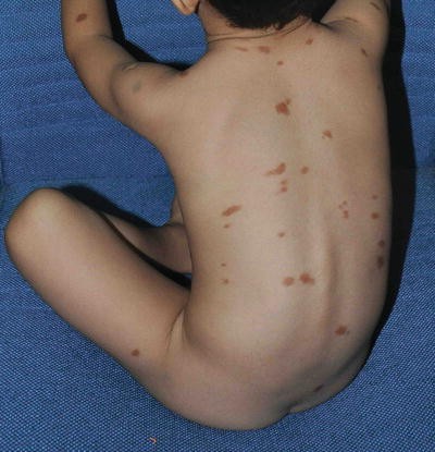 Pigmentary Development Of East Asian Skin Springerlink Pigmentary Development Of East Asian Skin Springerlink