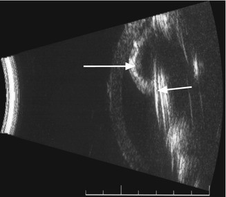 Case Study 4 Iris Bombe Around Intraocular Lens Implant Springerlink