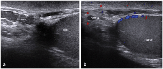 Scrotal Ultrasound Springerlink