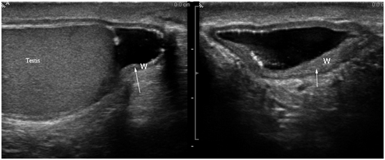 Scrotal Ultrasound Springerlink
