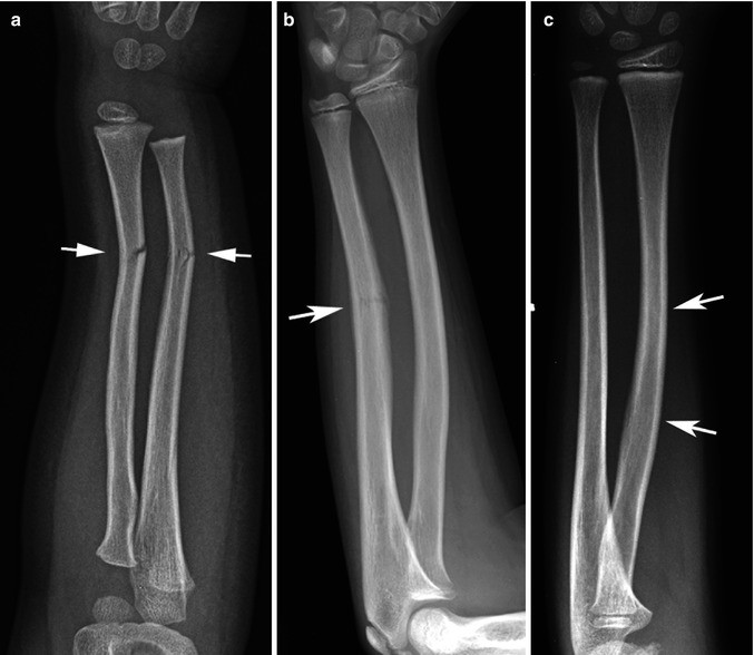 Types Of Fractures In Children SpringerLink