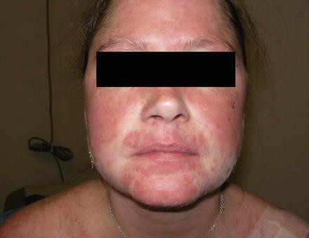 Malar Erythema Springerlink