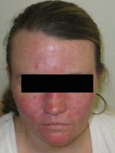 Malar Erythema Springerlink