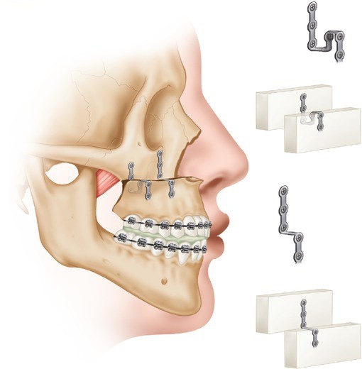 Maxillary Osteotomies SpringerLink