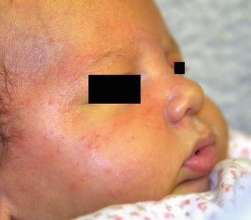 infantile neonatal acne fig