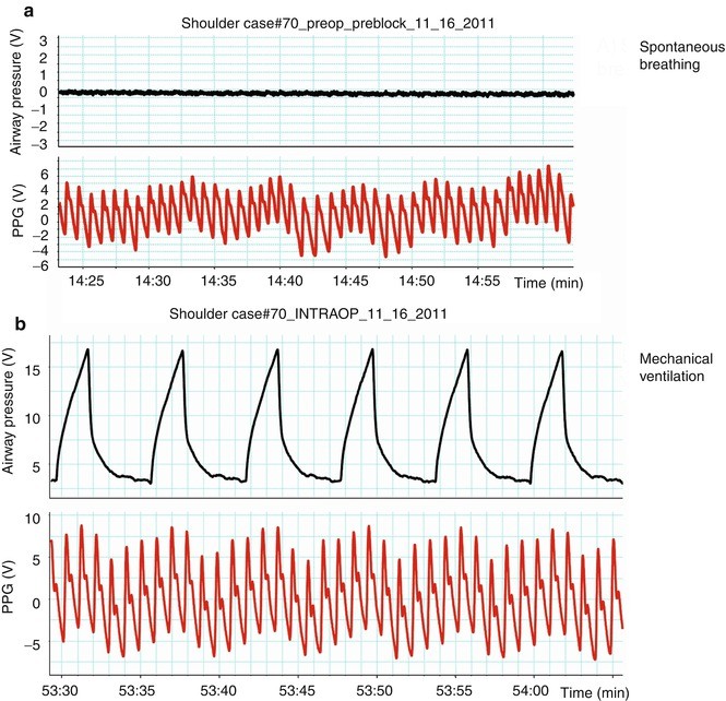 Photoplethysmography Analysis of the Pulse Oximeter Waveform
