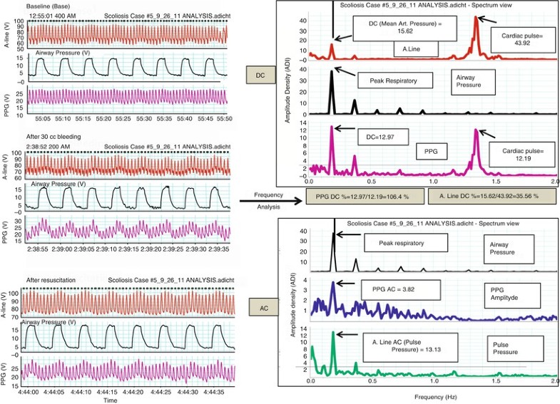 Photoplethysmography Analysis of the Pulse Oximeter Waveform