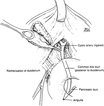 Extrahepatic Biliary Tract Springerlink