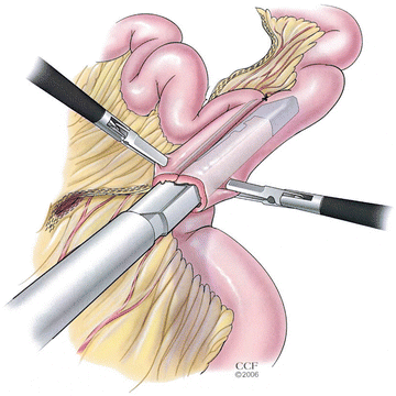 Bariatric Surgery | SpringerLink