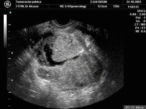 Malignant Ovarian Tumors Serous Mucinous Endometrioid Clear Cell Carcinoma Clinical Setting And Ultrasound Appearance Springerlink