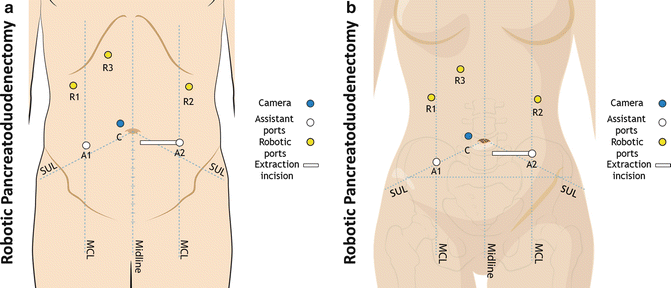 Robotic Pancreaticoduodenectomy Whipple Procedure Springerlink