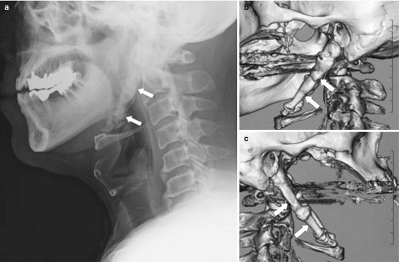 Glossopharyngeal Nerve Block SpringerLink