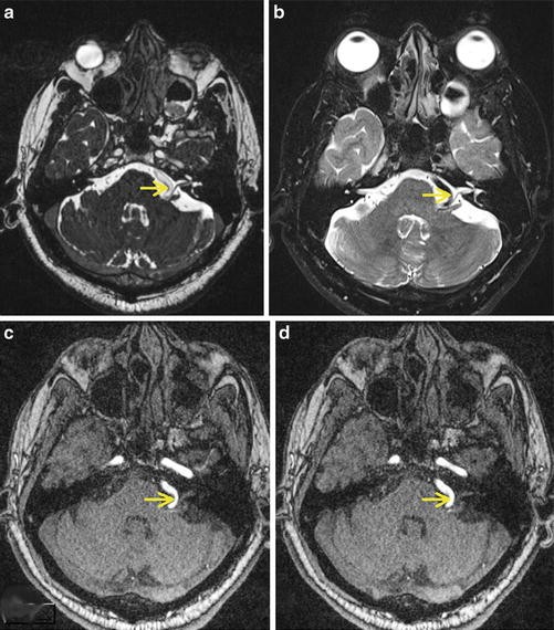 aica and pica syndrome