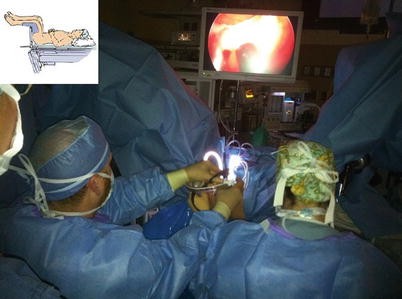 Transanal Minimally Invasive Surgery (TAMIS) | SpringerLink