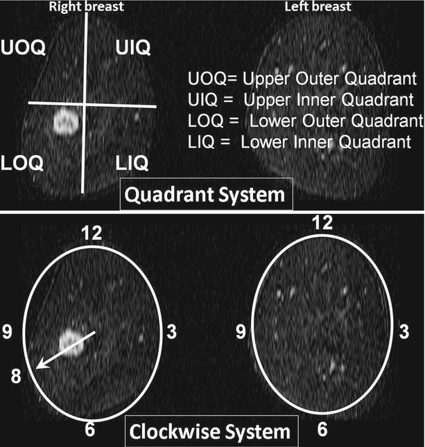 Breast Mri For Diagnosis And Staging Of Breast Cancer Springerlink Breast Mri For Diagnosis And Staging Of Breast Cancer Springerlink