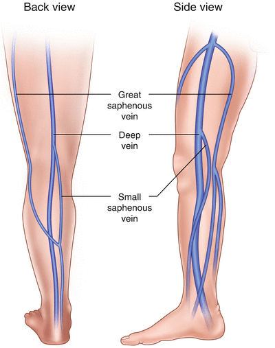 the vein stripping ablation and phlebectomy springerlink small saphenous vein