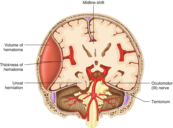 Decompressive Craniotomy in Trauma | SpringerLink