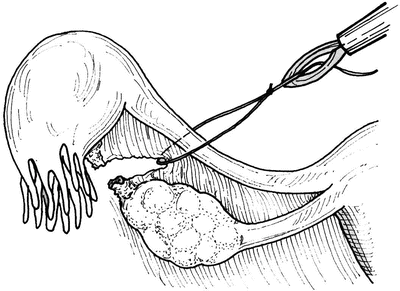 Surgical Management Of Ectopic Pregnancy Springerlink