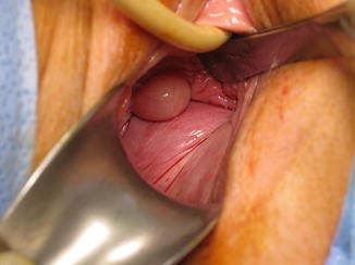 Excision Of Vaginal Cysts Springerlink