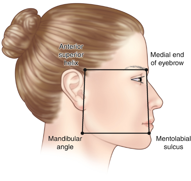 mentolabial fold filler