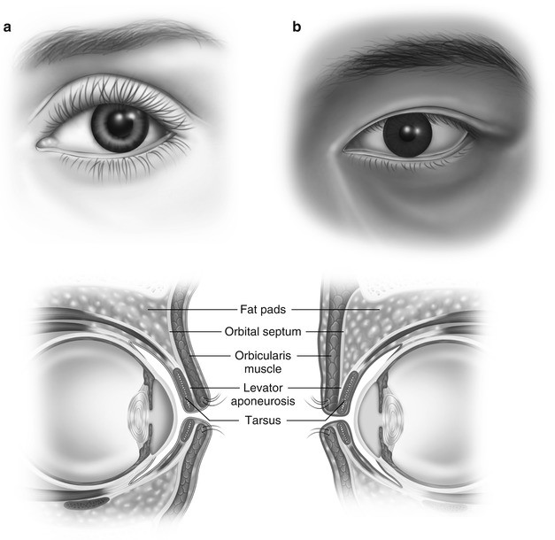 Recognizing The Differences In Asian Eyelid Anatomy Springerlink