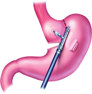 stapler circular gastric bypass division staple gia transgastric technique line tube