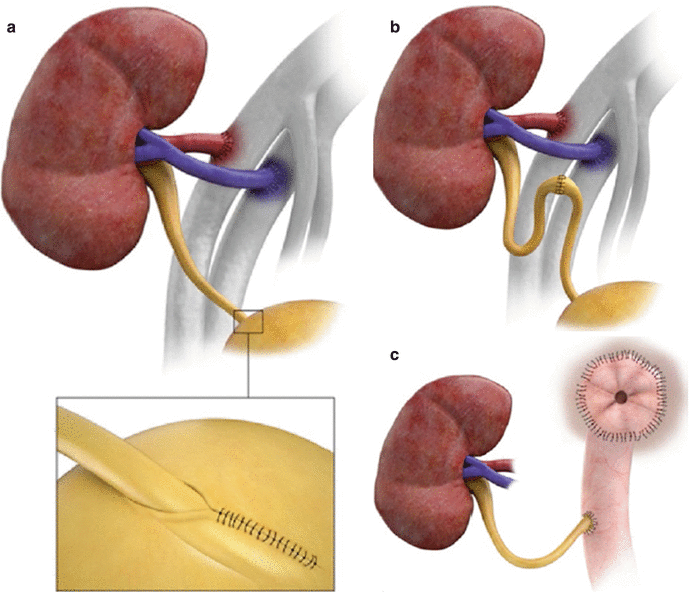 Imaging of Kidney Transplant SpringerLink