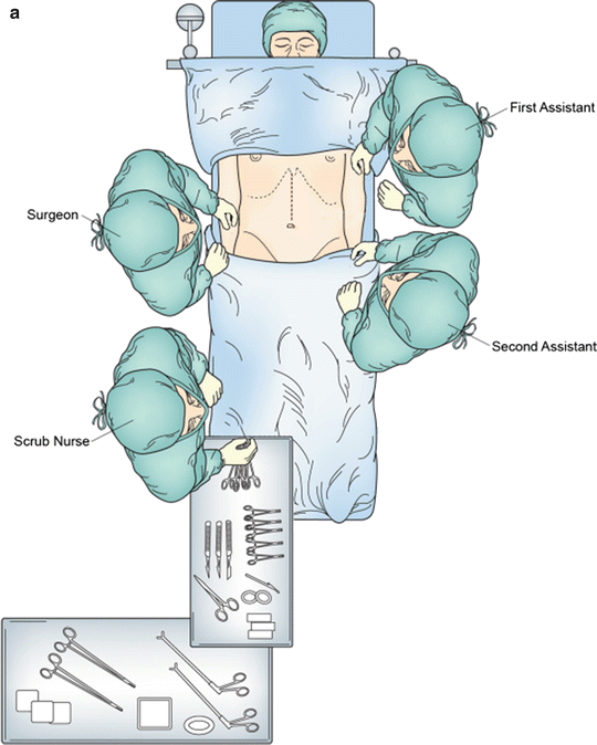 Open Technique for Ivor Lewis Esophagectomy | SpringerLink