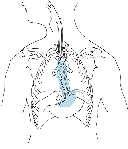hammer lymph anvil ear hammer lymph anvil ear