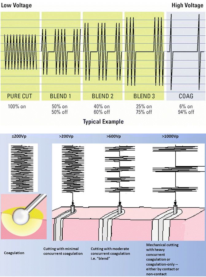 Electrocautery for ESD SpringerLink