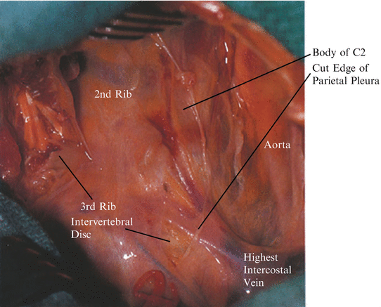 Third Rib Resection In The Transthoracic Approach Springerlink