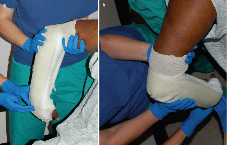 SugarTong Splint SpringerLink