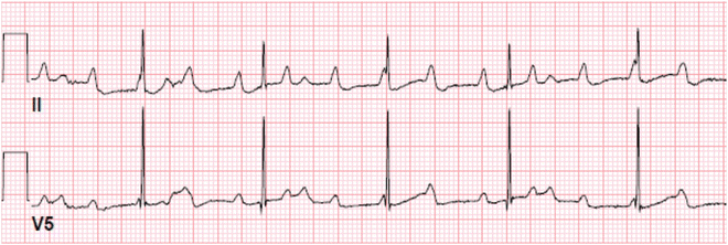 Complete Atrioventricular Block Third Degree Heart Block