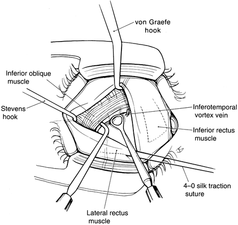 A And V Pattern Strabismus Springerlink