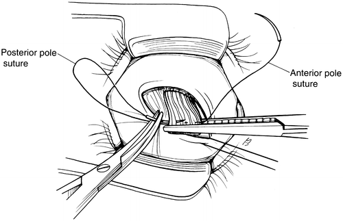 A And V Pattern Strabismus Springerlink