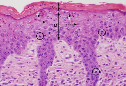 fekete papillomatosis dermatosis)
